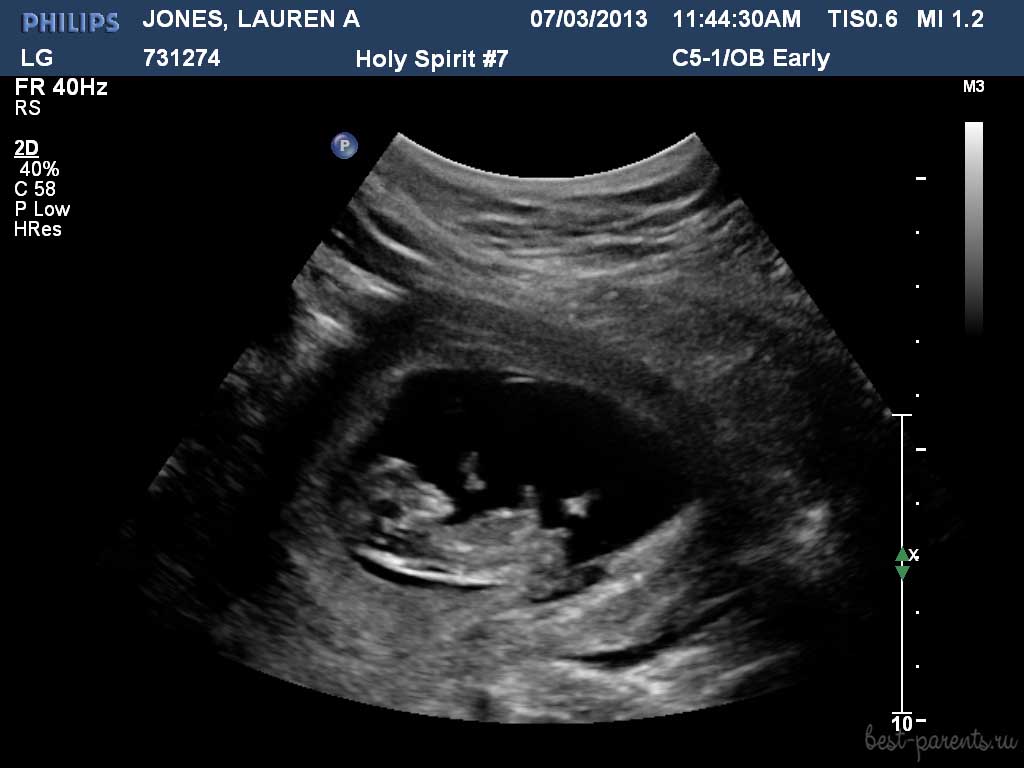 беременность фото УЗИ 11 недель
