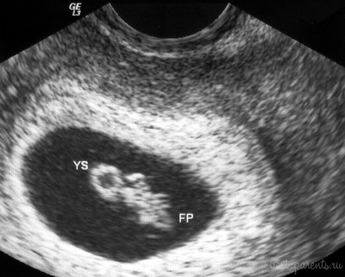 УЗИ 7 недель беременности