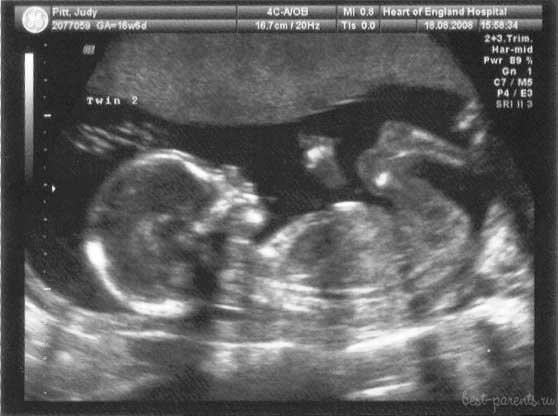 фото УЗИ 17 недель беременности