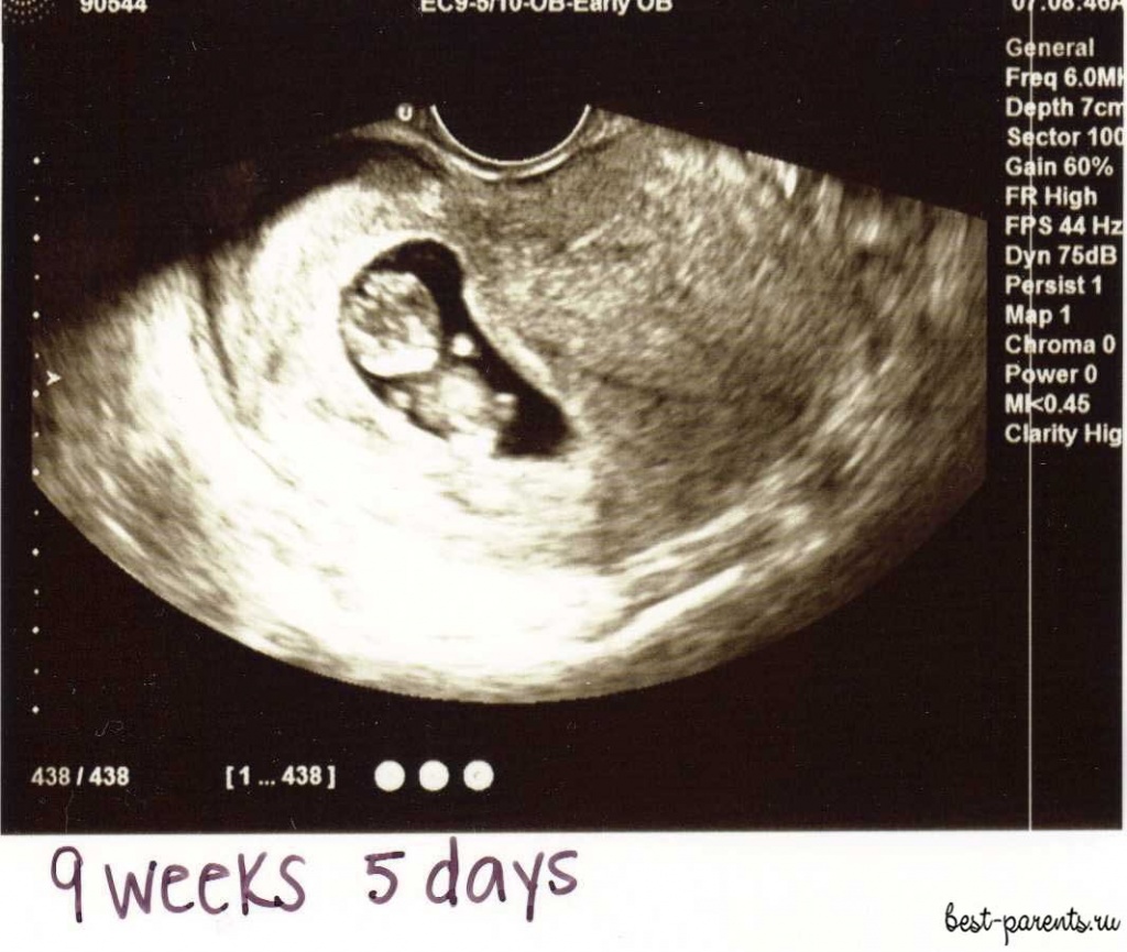 9 недель беременности фото УЗИ