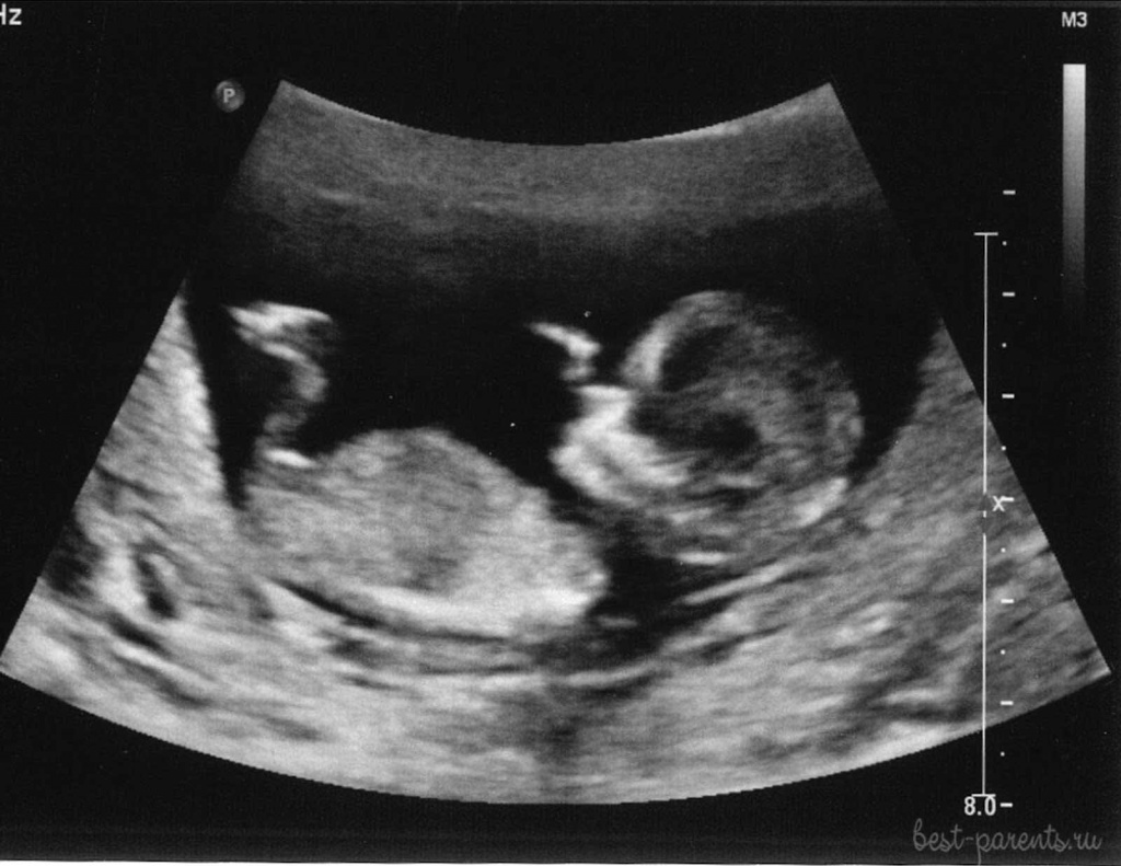 беременность 25 недель фото УЗИ