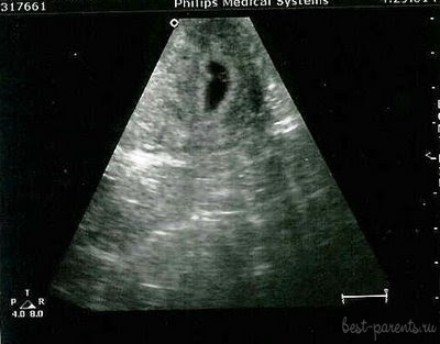 Беременность 4 недели УЗИ