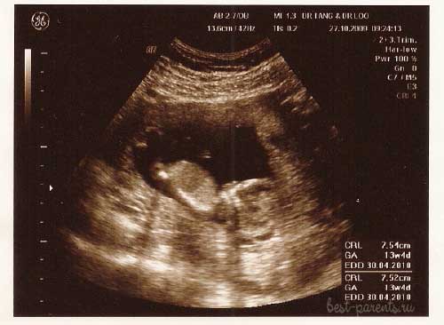 фото УЗИ 13 недель беременности