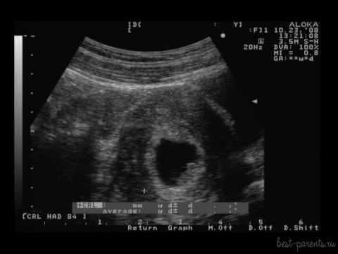 7-8 недель беременности УЗИ