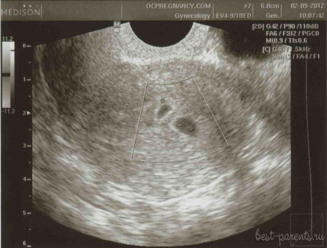 Беременность 5 недель фото УЗИ