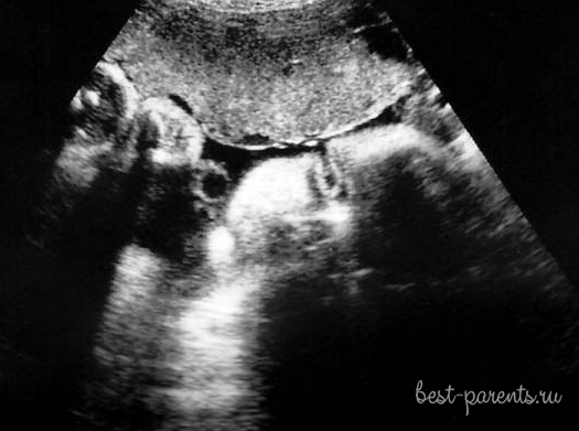 фото УЗИ 33 недели беременности