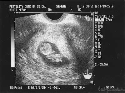 УЗИ на 9 неделе беременности