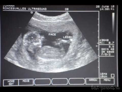 фото УЗИ 14 недель беременности