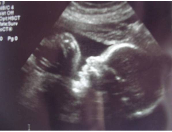 29 неделя беременности фото УЗИ