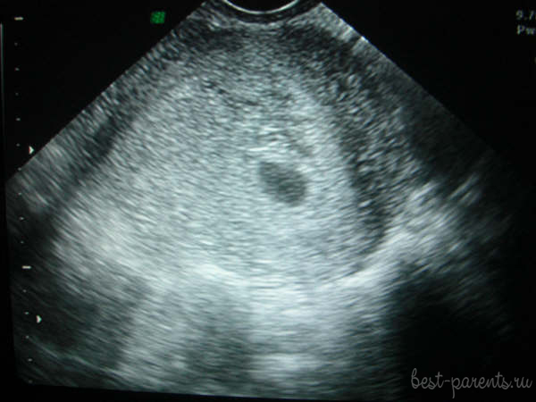 4 недели беременности УЗИ